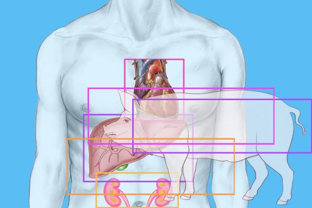 Pig-human transplants may be a misguided attempt to address the